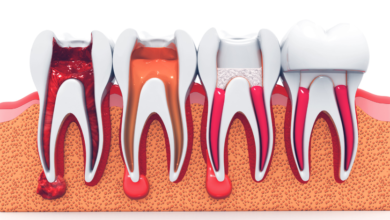Understanding the Process of Root Canal Treatment